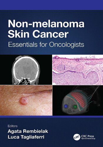 Non Melanoma Skin Cancer Essentials for Oncologists